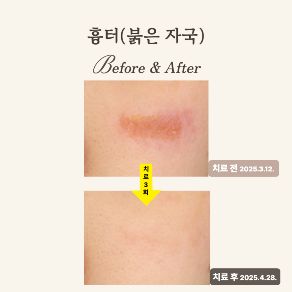 20대, 브이빔 레이저로 붉은 흉터 자국 치료 후기