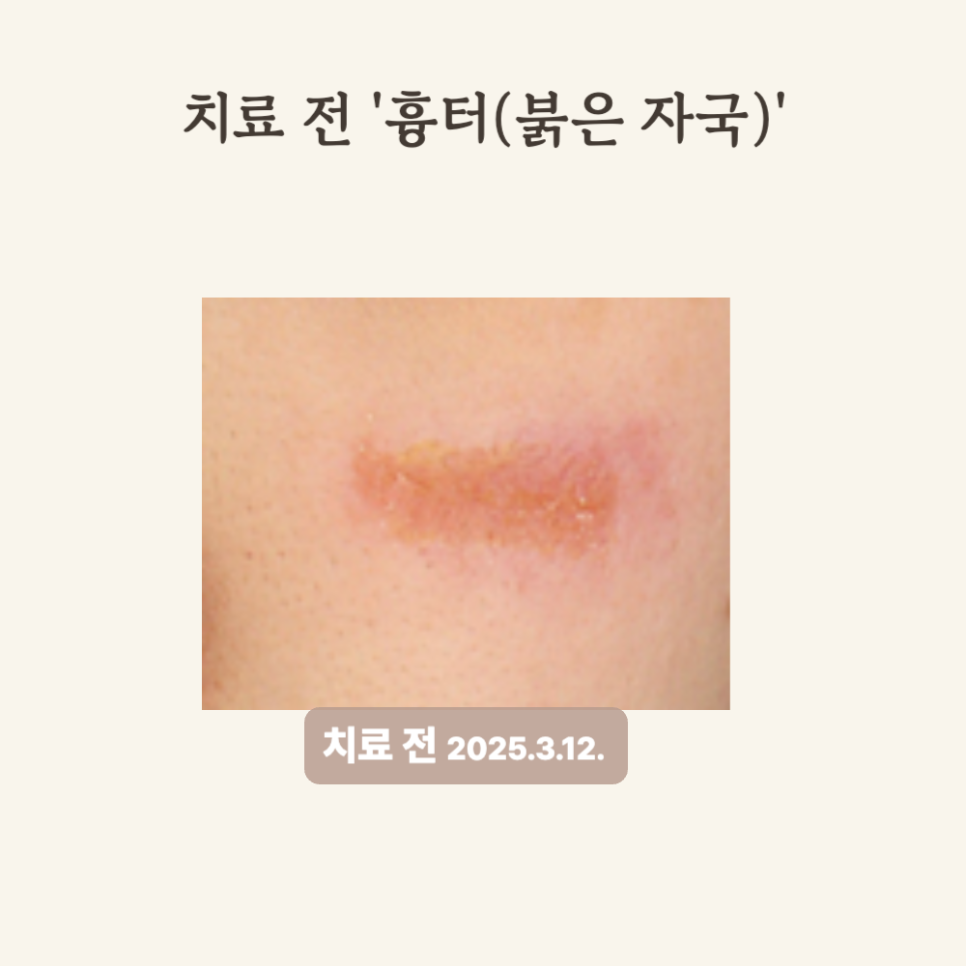 20대, 브이빔 레이저로 붉은 흉터 자국 치료 후기