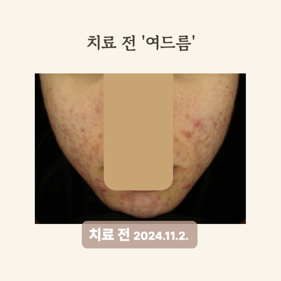 10대의 여드름 흉터, 붉은 자국, 브이빔 레이저 치료 후기