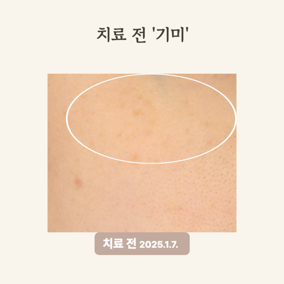30대 눈가 기미, 레이저 토닝과 PRP시술 후기