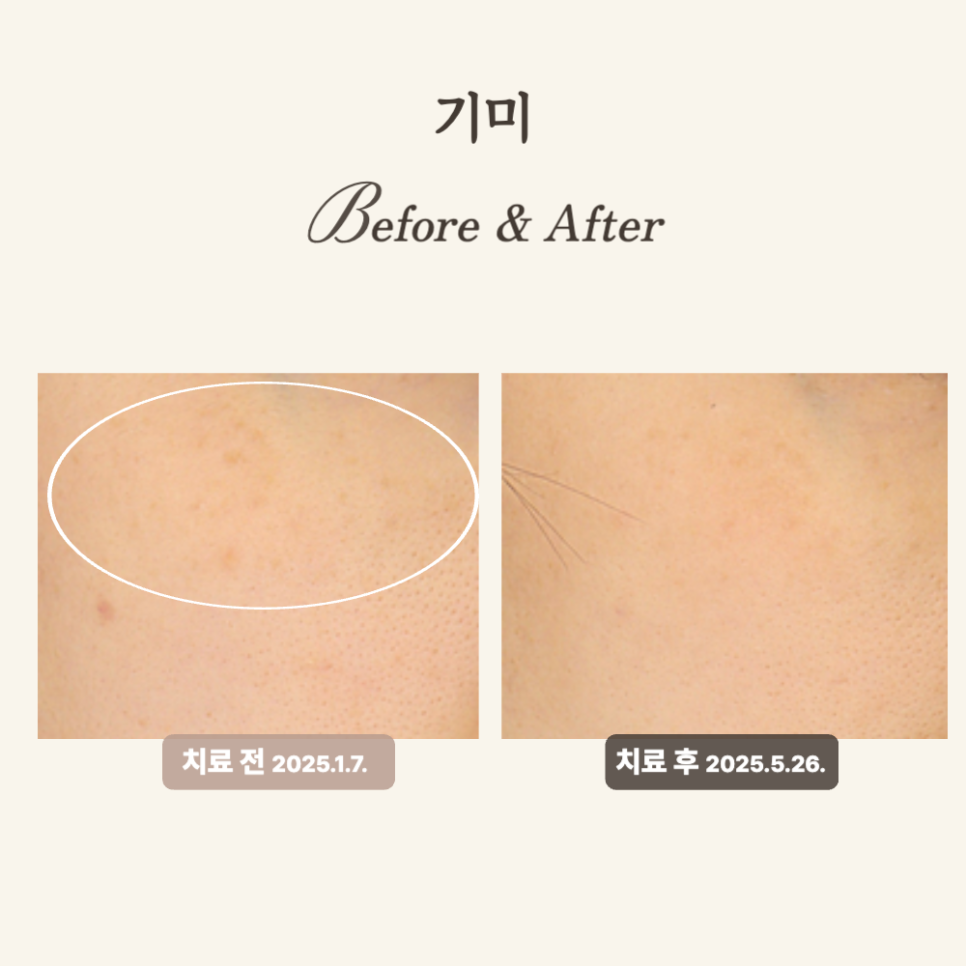 30대 눈가 기미, 레이저 토닝과 PRP시술 후기