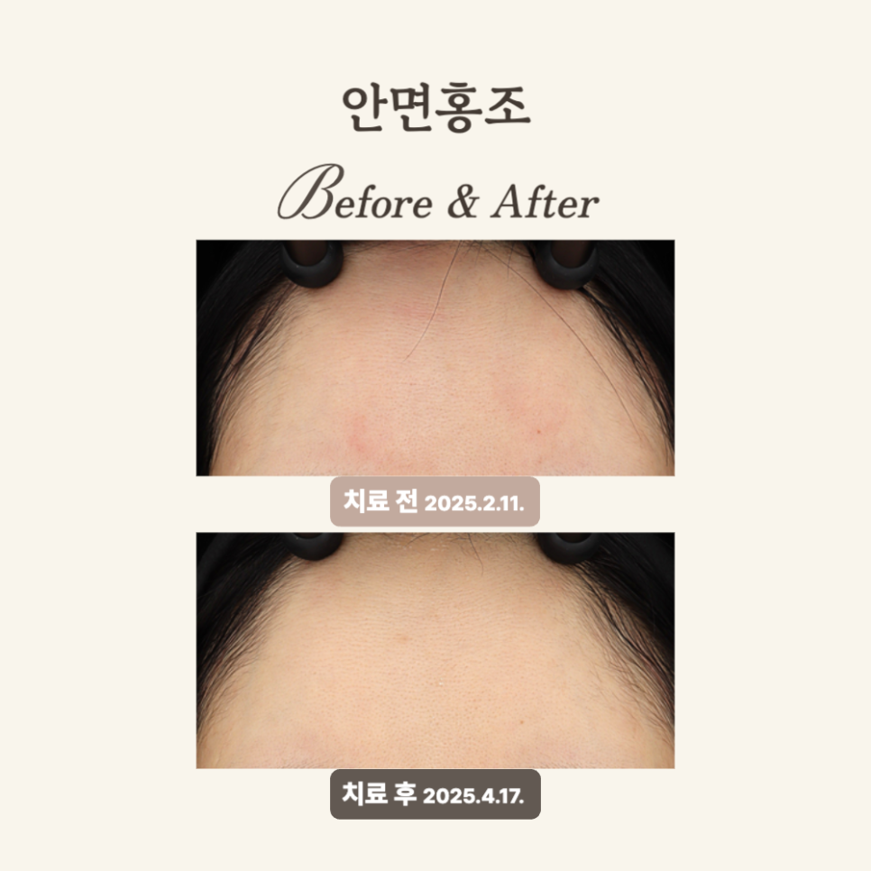 민감성 피부를 위한 브이빔 레이저 치료 후기