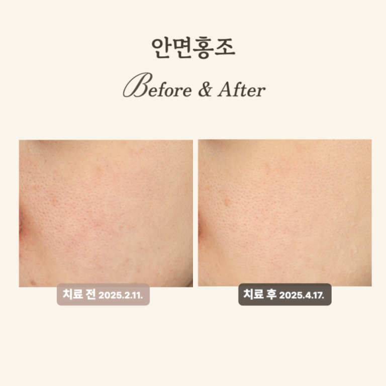 민감성 피부를 위한 브이빔 레이저 치료 후기