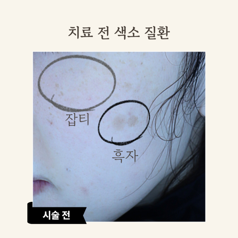 30대 피코 레이저 시술 후기: 잡티 제거와 피부 톤 개선