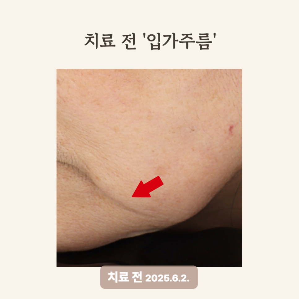 50대 레디어스 시술 후기: 입가 주름과 턱선 복원!