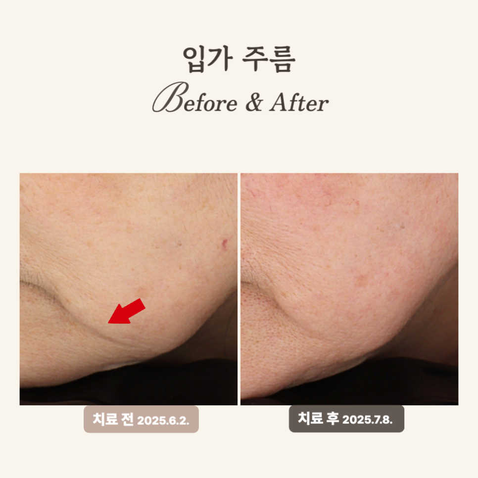 50대 레디어스 시술 후기: 입가 주름과 턱선 복원!