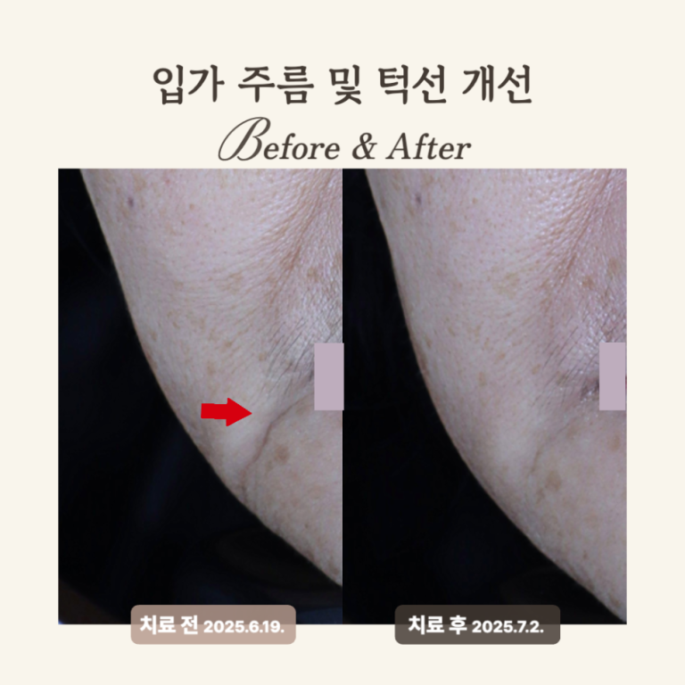 60대 레디어스 시술 후기: 입가 주름 개선과 탄력 회복의 비결