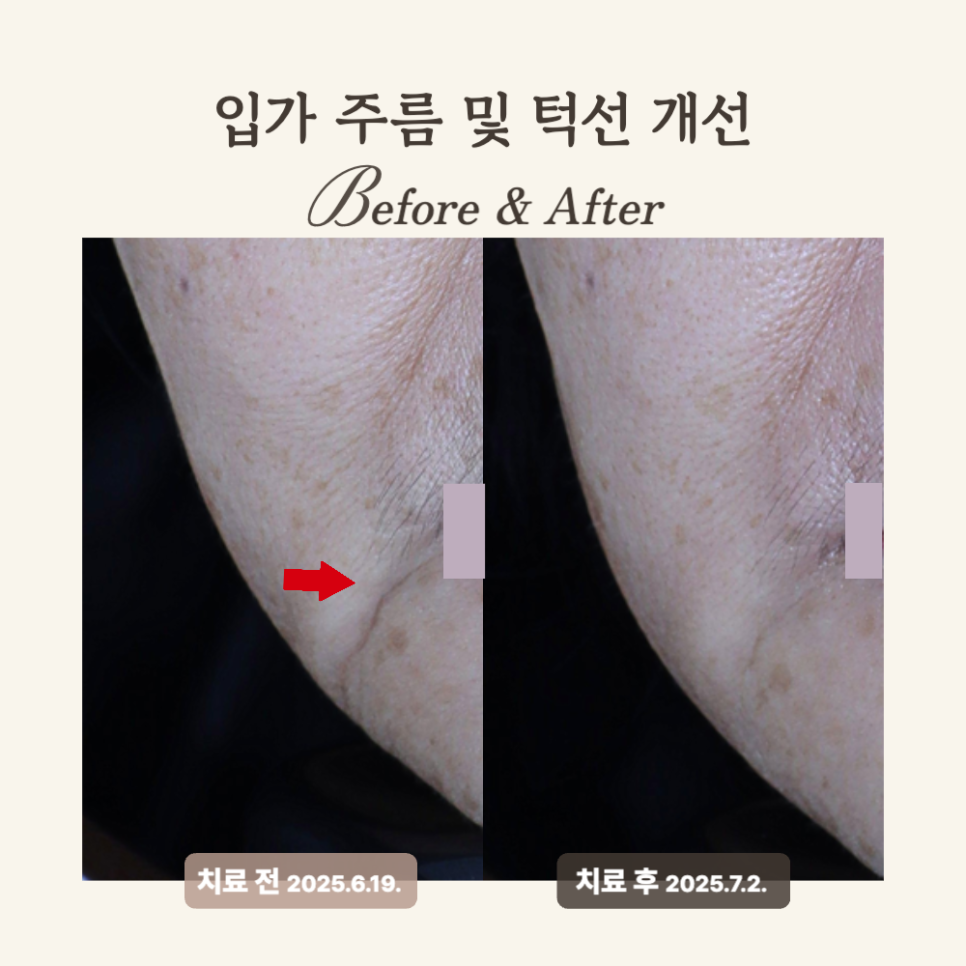 60대 레디어스 시술 후기: 입가 주름 개선과 탄력 회복의 비결