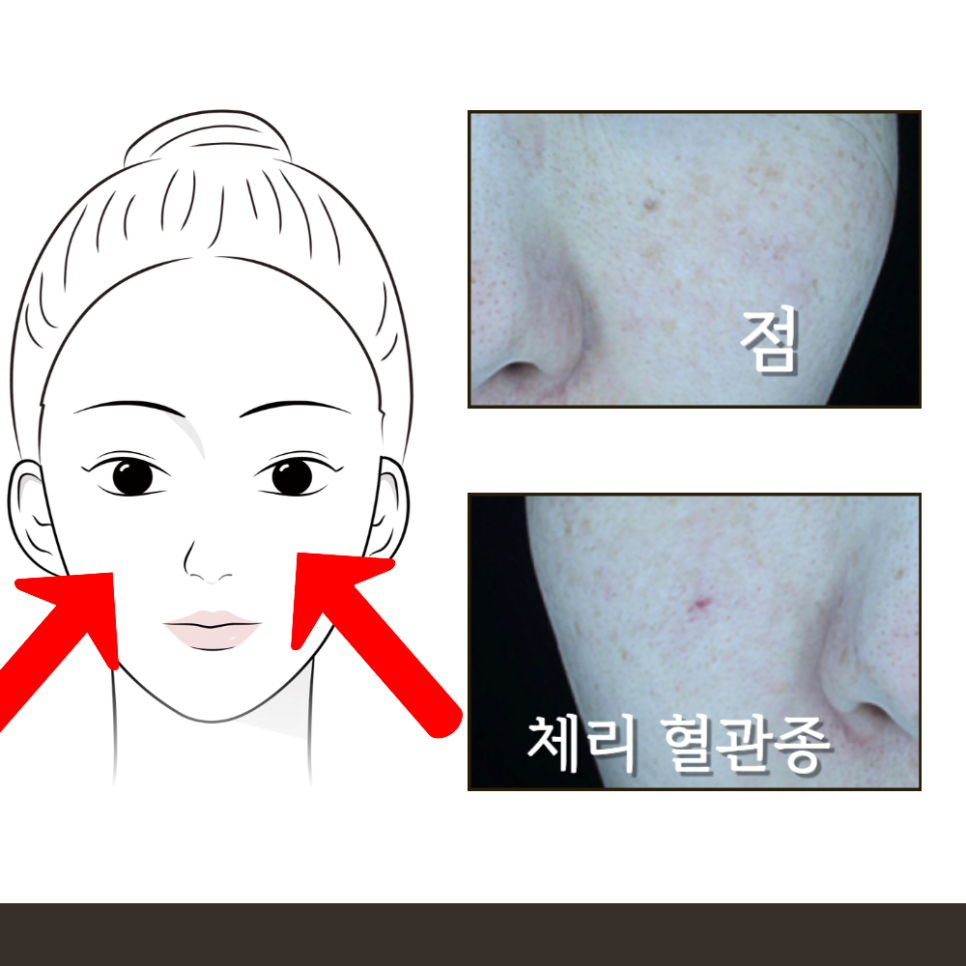 30대 브이빔 레이저 시술 후기: 피부톤 개선과 체리 혈관종 제거