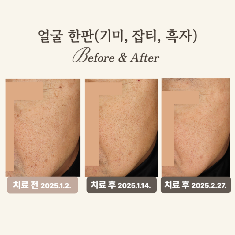 60대 진피형 기미, 레이저 토닝 후기