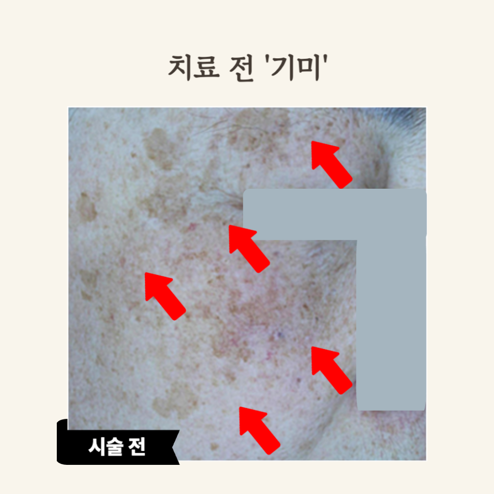 60대 레이저 토닝 후기: 기미·잡티 개선 성공