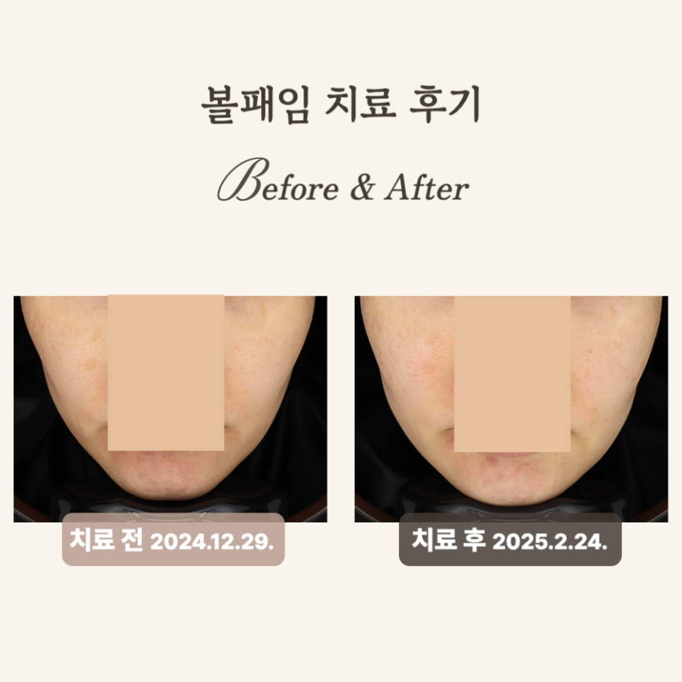 40대 울트라콜·쥬베룩 후 젊어진 얼굴 후기