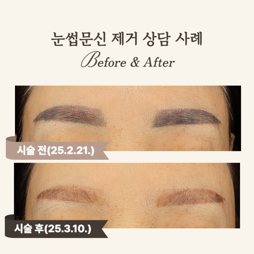 50대 눈썹문신 피코토닝 후 자연스러운 변화 후기