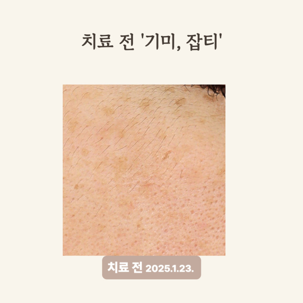 30대 눈 아래 잡티 개선, 피코토닝 듀얼토닝 후기로 확인하세요