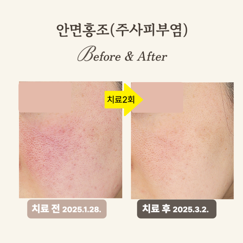 브이빔 레이저 30대 안면홍조 시술 후기: 효과적인 치료!