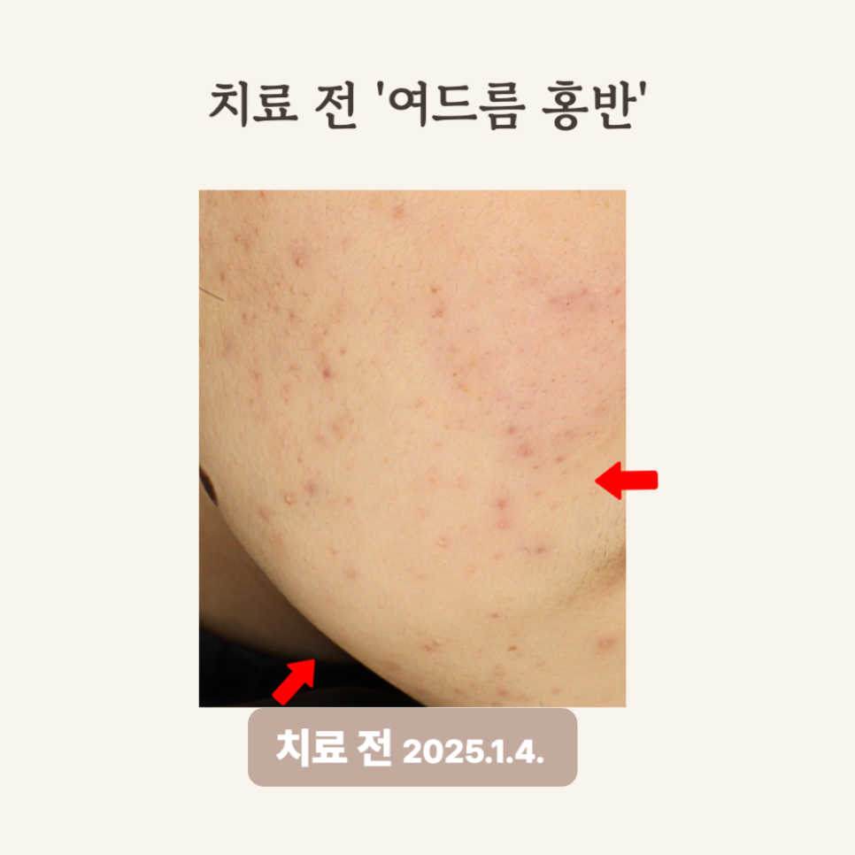 10대 여드름 붉은 자국, 브이빔 시술 후기