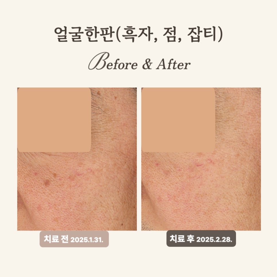 50대 눈가, 볼 흑자 레이저 치료 후기