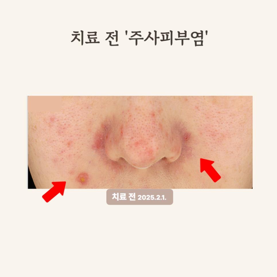 20대 민감성 피부, 브이빔 2회로 주사피부염 극복 후기