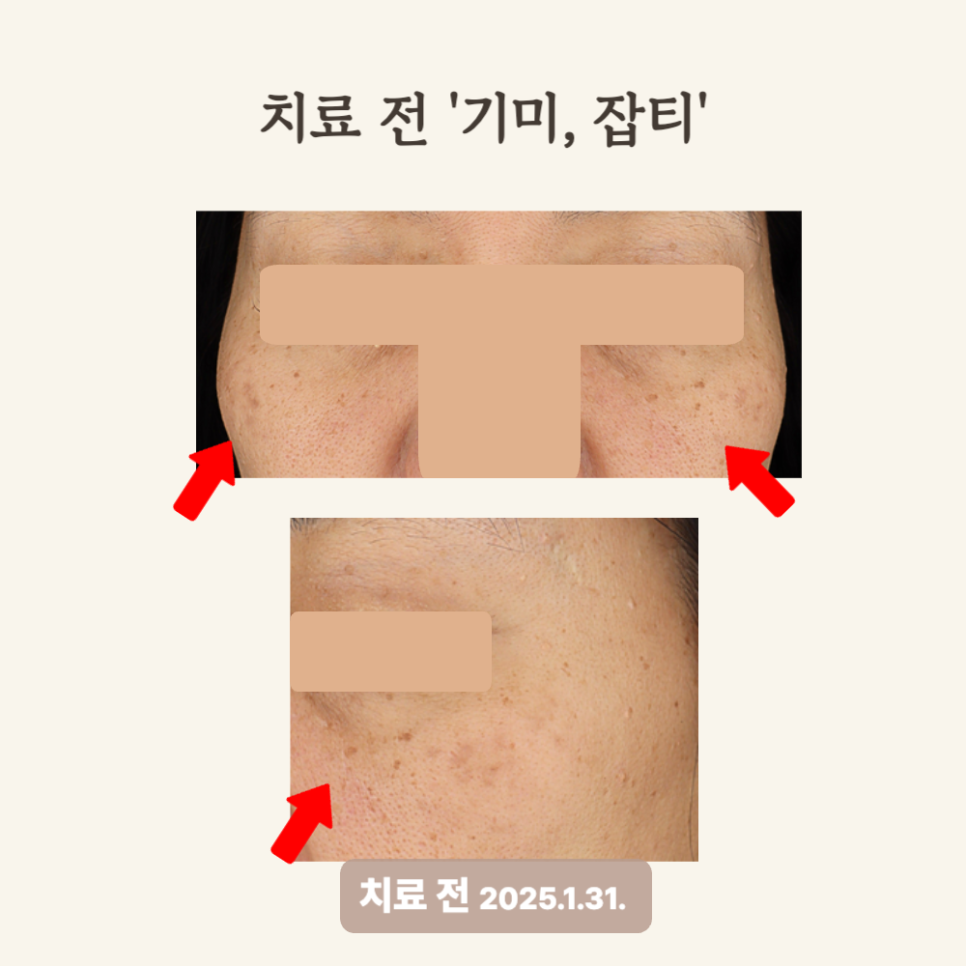 50대 잡티와 기미 치료 후기: 피코토닝과 레이저토닝
