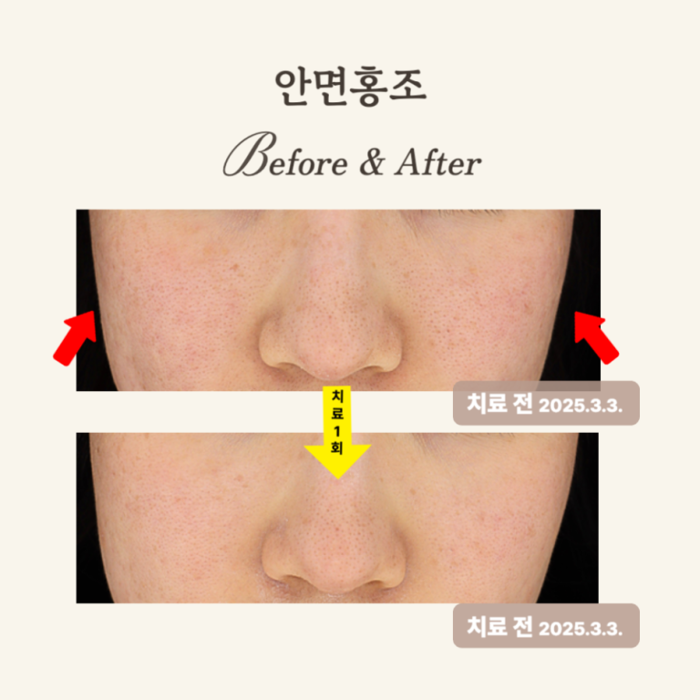 20대 민감성 피부, 브이빔 레이저 1회 시술 후기