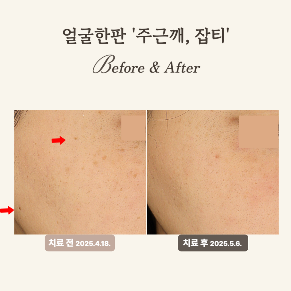 30대, 레이저토닝으로 주근깨 잡티 시술 후기