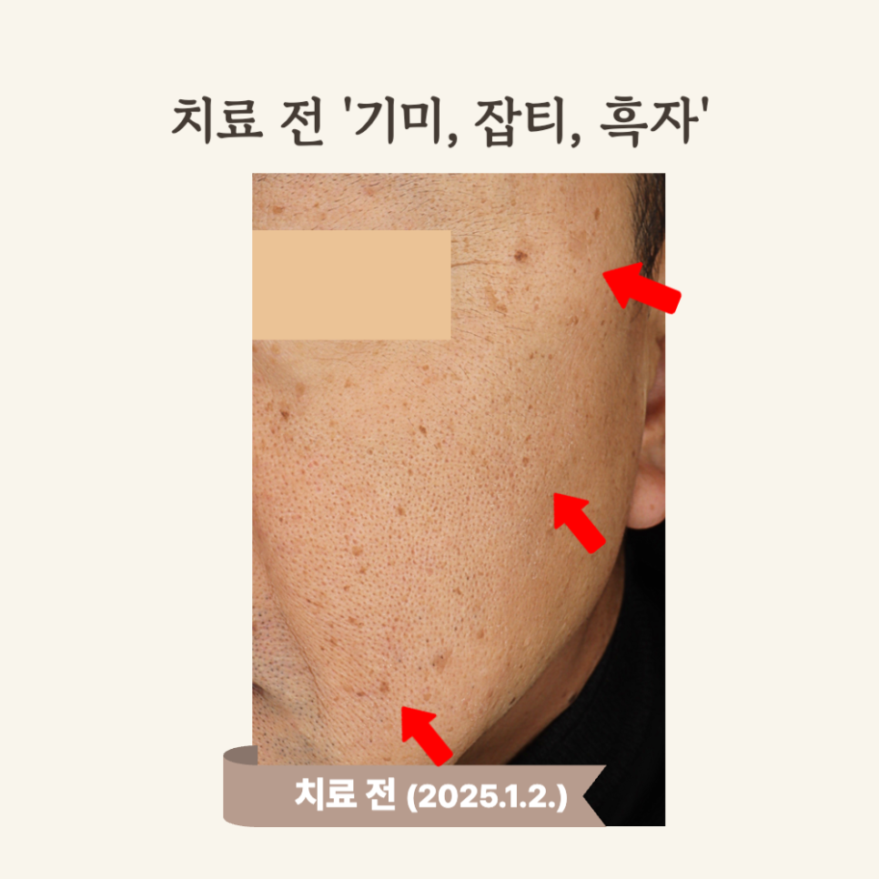 60대 얼굴한판 시술 후기: 피코토닝으로 기미·흑자 개선!