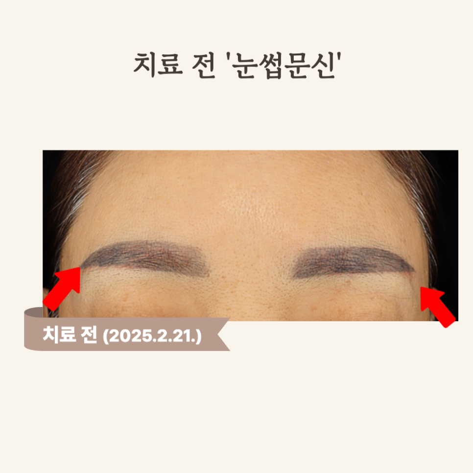 50대 눈썹문신 피코토닝 후 자연스러운 변화 후기