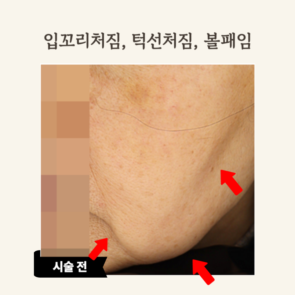 60대 울쎄라 시술 후기: 탄력있는 턱선으로 젊음 회복!