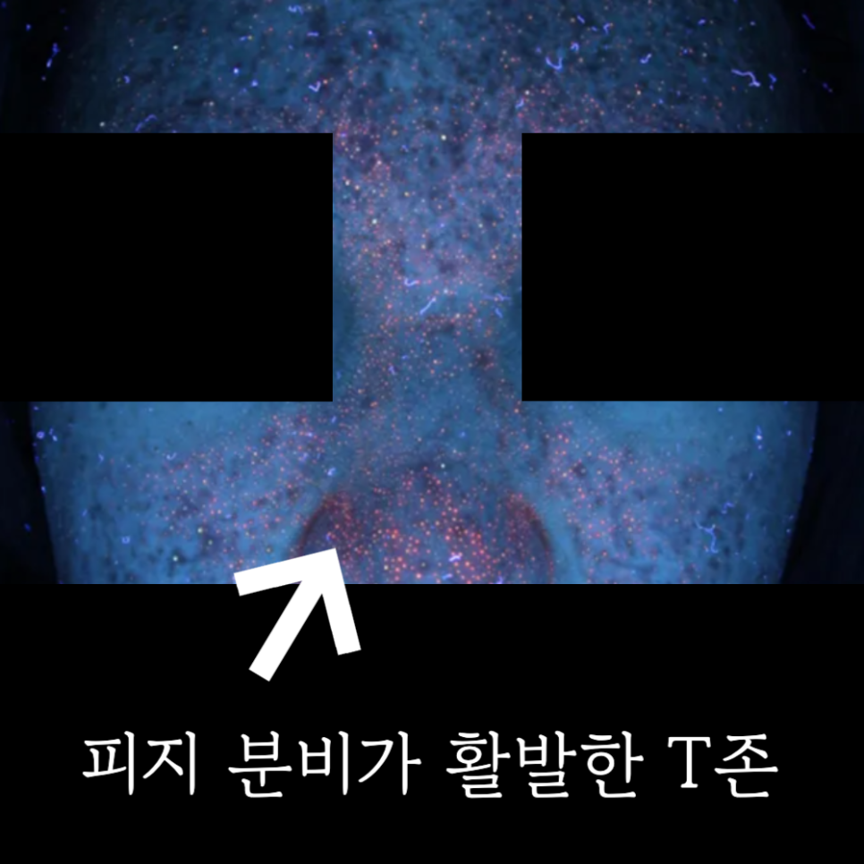 10대 염증성 여드름, Gold PTT 시술 후 달라진 피부