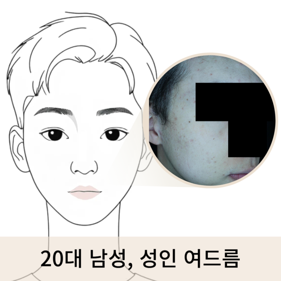 20대 성인 여드름 붉은자국, 브이빔 레이저 시술 후기