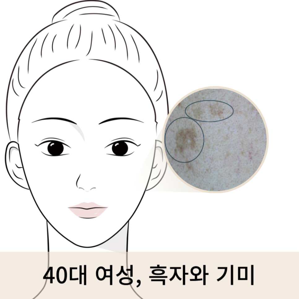 40대 기미·흑자 해결! 피코 레이저 치료 후기