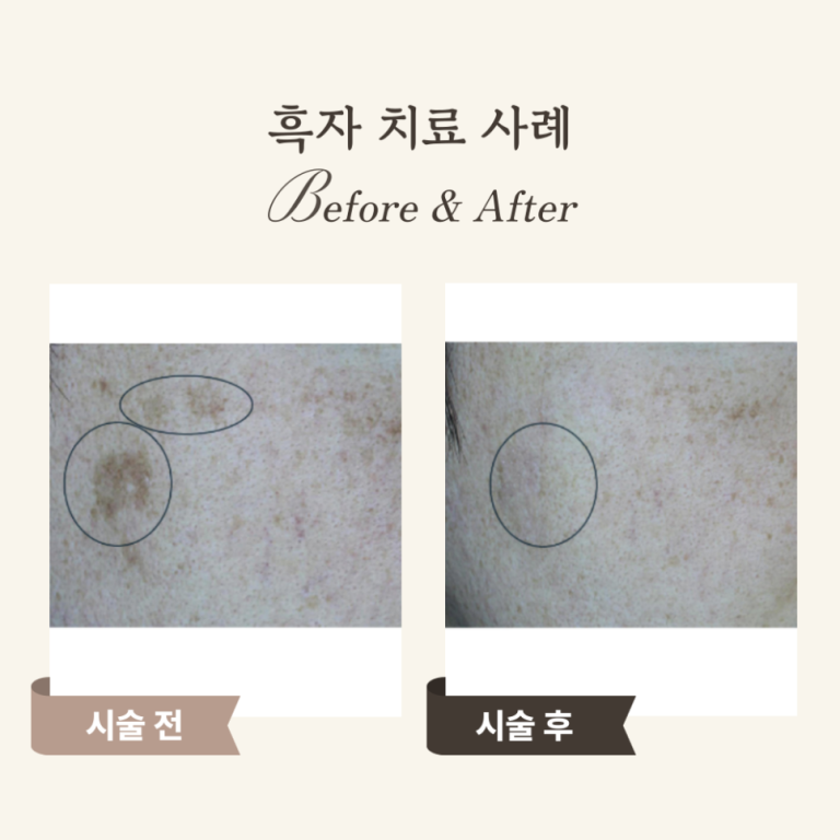 40대 기미·흑자 해결! 피코 레이저 치료 후기