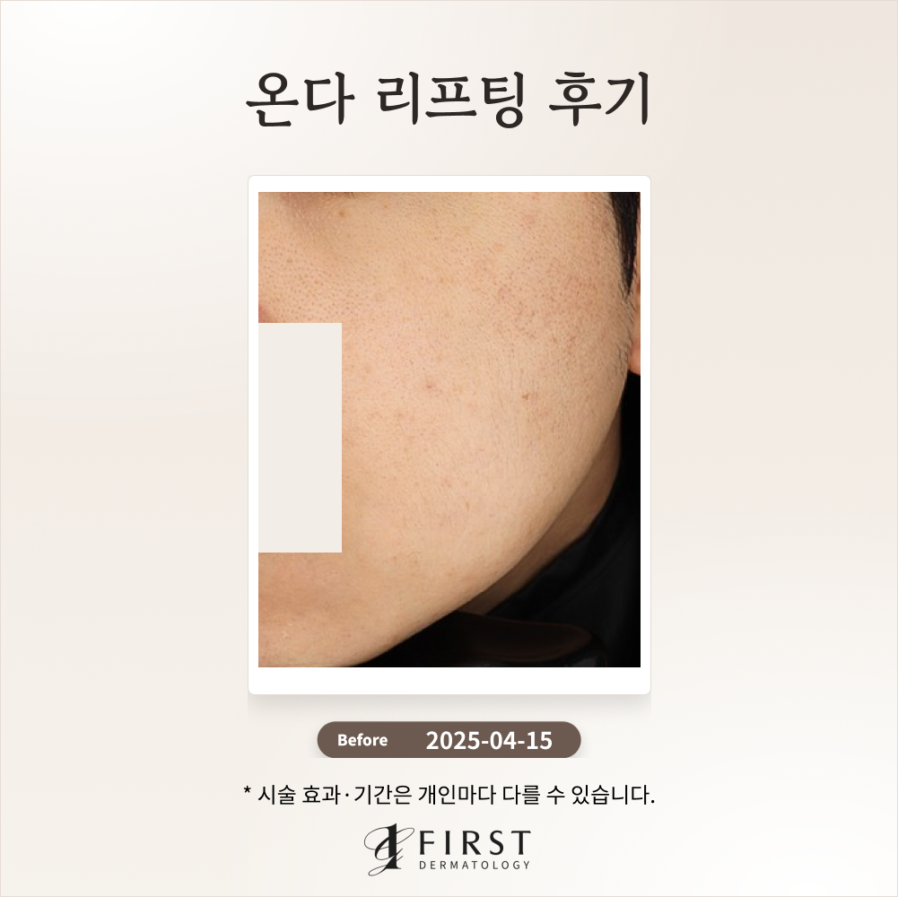 온다 얼굴 리프팅 후기_광교퍼스트피부과