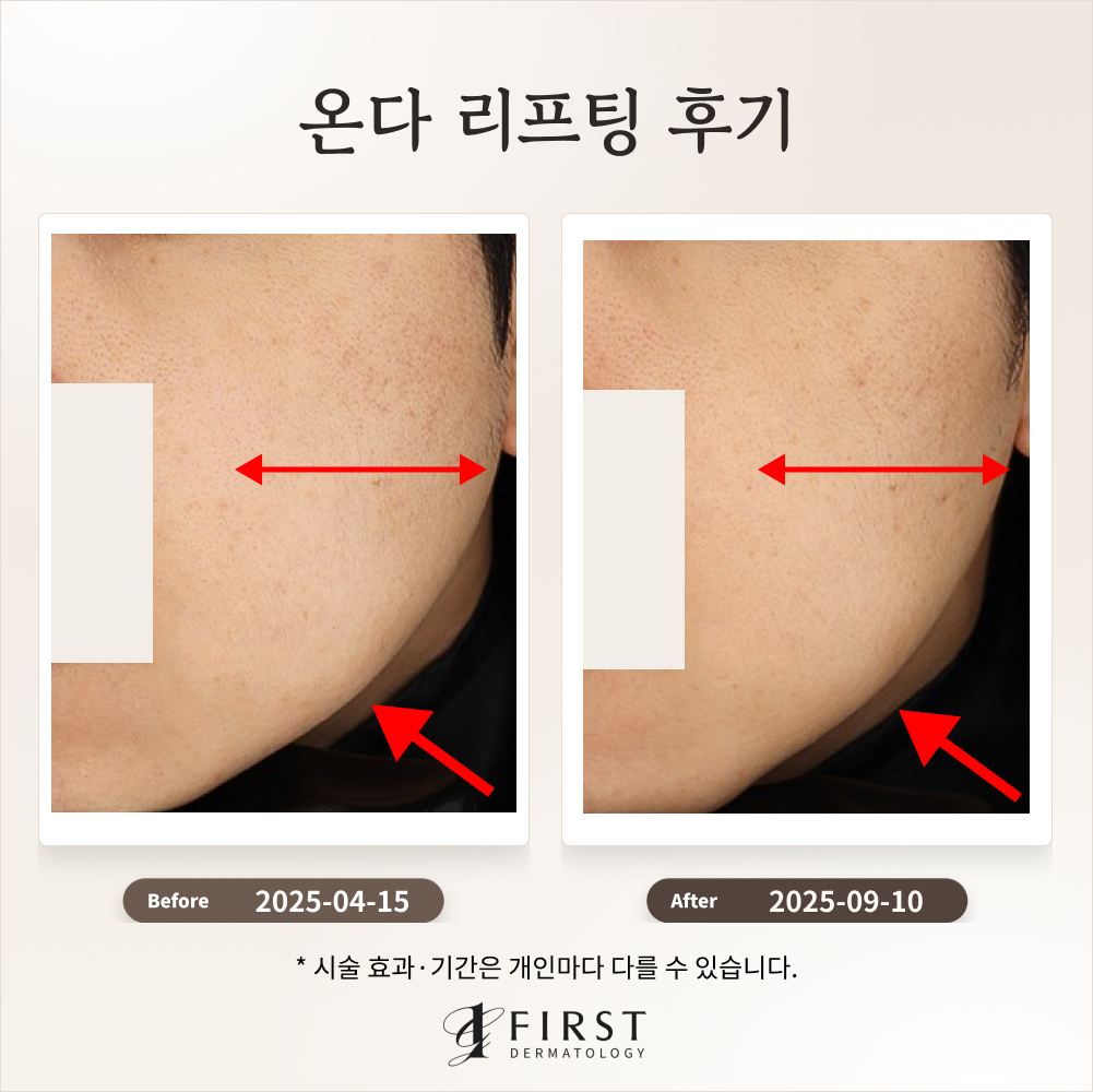 온다 얼굴 리프팅 후기_광교퍼스트피부과