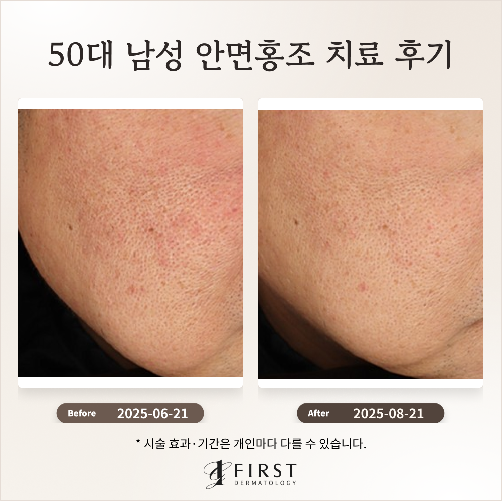 50대 남성 안면홍조 치료 후기_수원피부과 후기