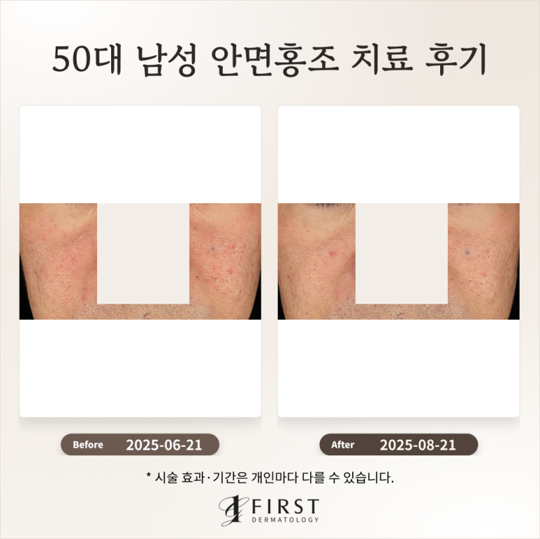 50대 남성 안면홍조 치료 후기_수원피부과 후기