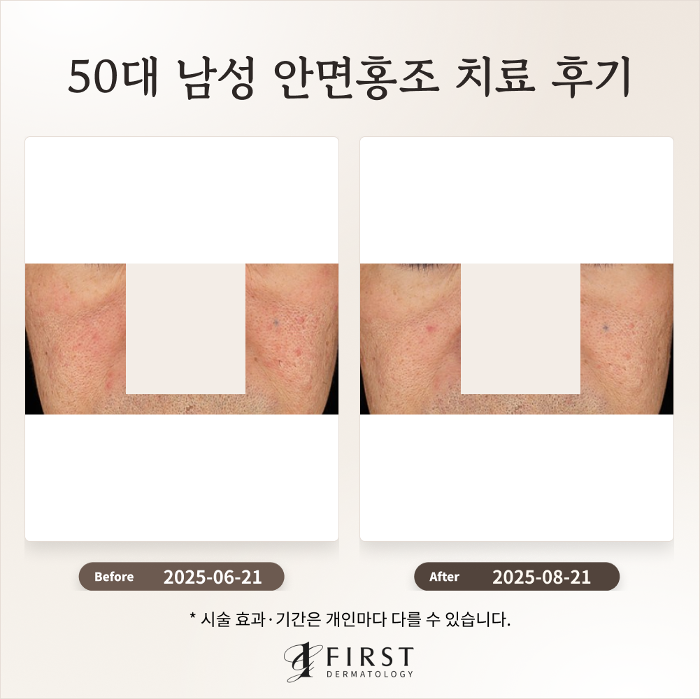 50대 남성 안면홍조 치료 후기_수원피부과 후기