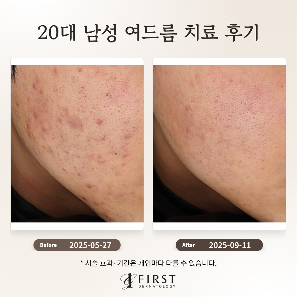 20대 남성 여드름 치료 후기_수지여드름피부과 후기