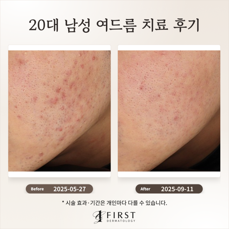 20대 남성 여드름 치료 후기_수지여드름피부과 후기