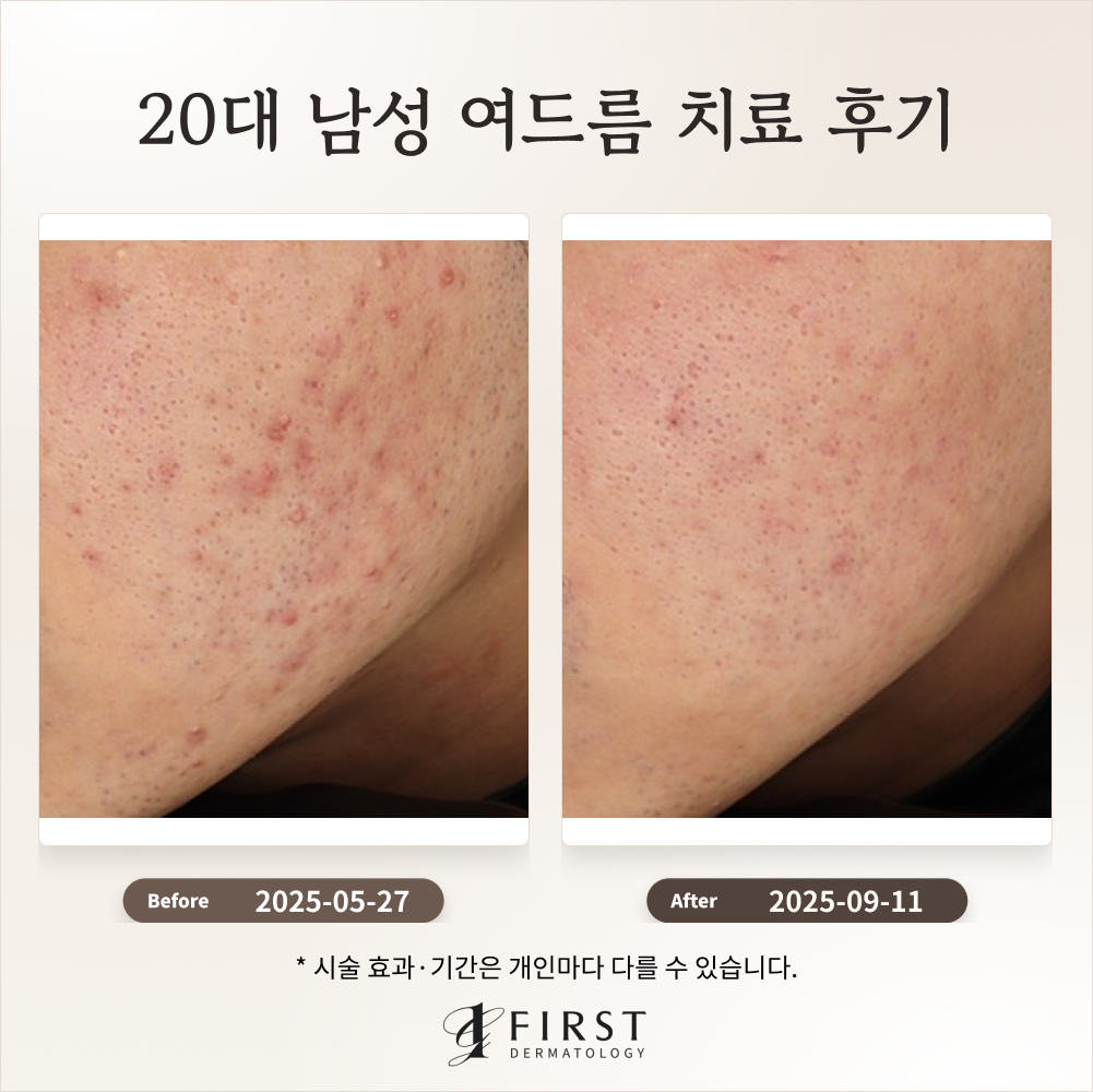 20대 남성 여드름 치료 후기_수지여드름피부과 후기