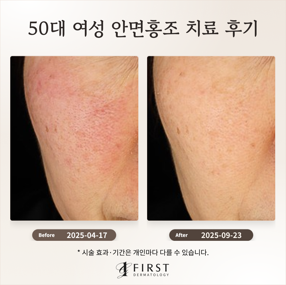 50대 여성 안면홍조 치료 후기(만성 홍조)