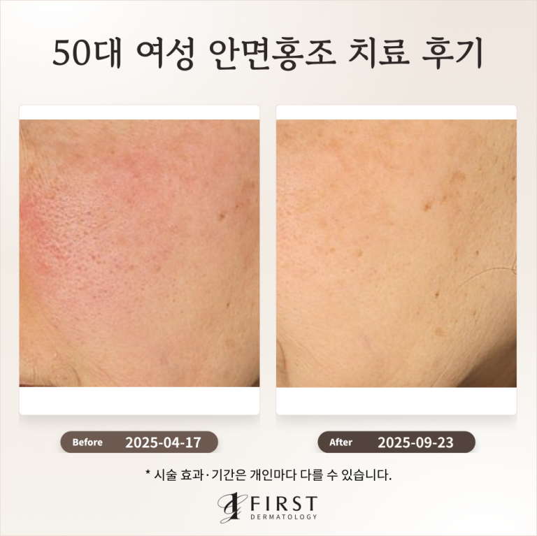 50대 여성 안면홍조 치료 후기(만성 홍조)