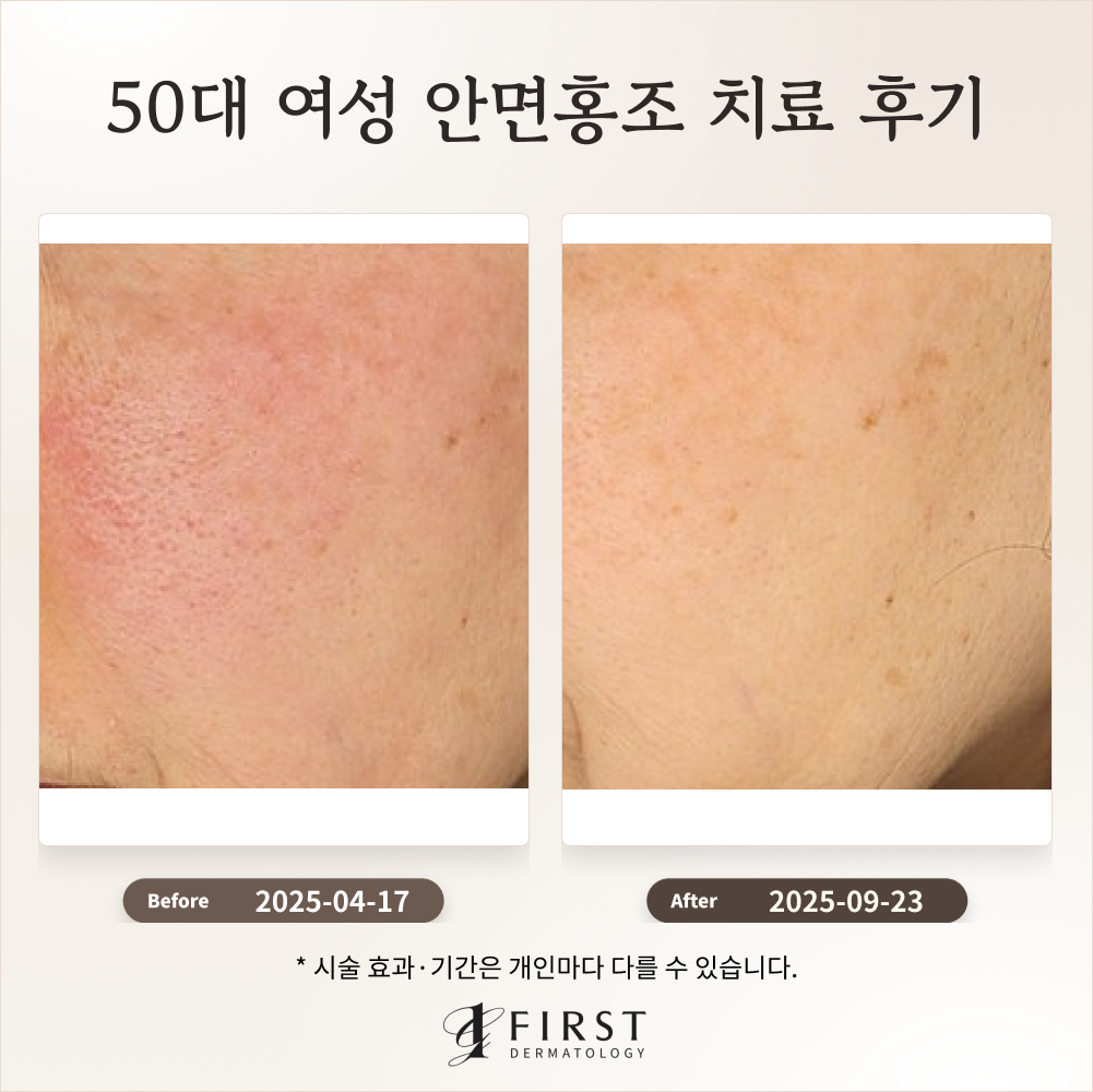 50대 여성 안면홍조 치료 후기(만성 홍조)