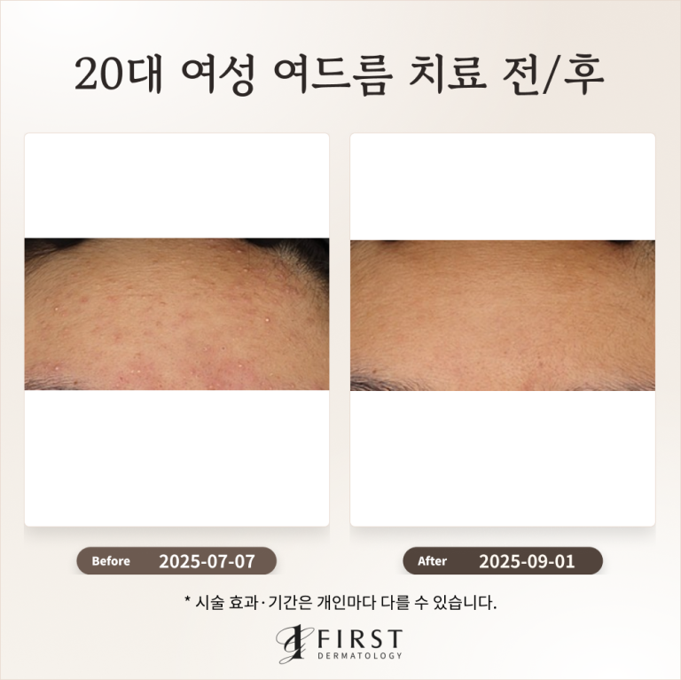 20대 여성 여드름 붉은 자국 치료 후기_수지여드름피부과