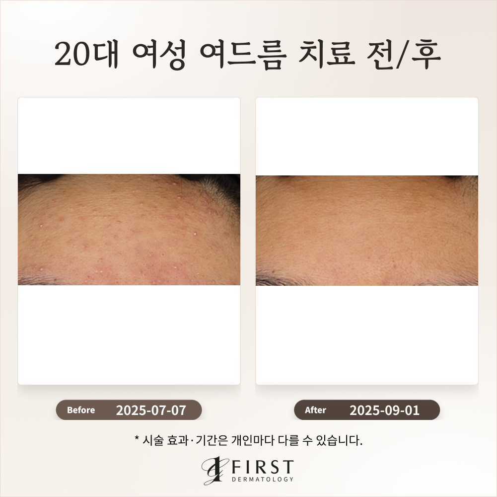20대 여성 여드름 붉은 자국 치료 후기_수지여드름피부과