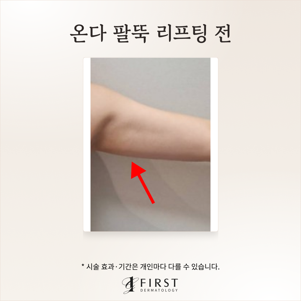 40대 온다 바디 리프팅 후기 #군살제거 가능할까?