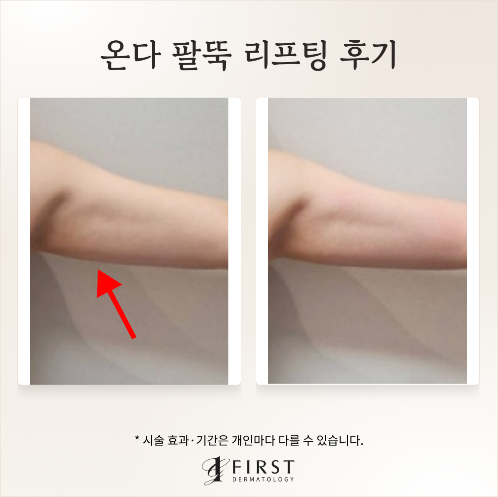 40대 온다 바디 리프팅 후기 #군살제거 가능할까?