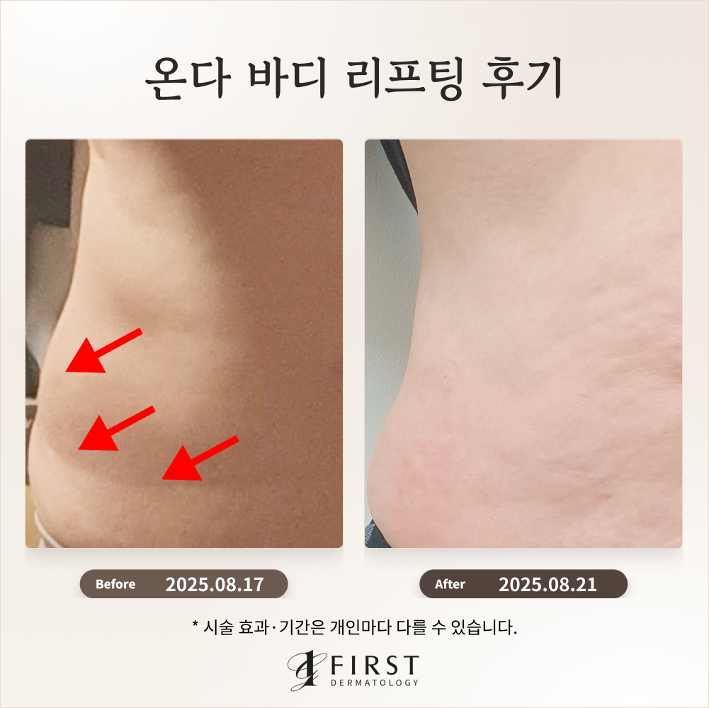 40대 여성 뱃살 군살 온다 리프팅 후기