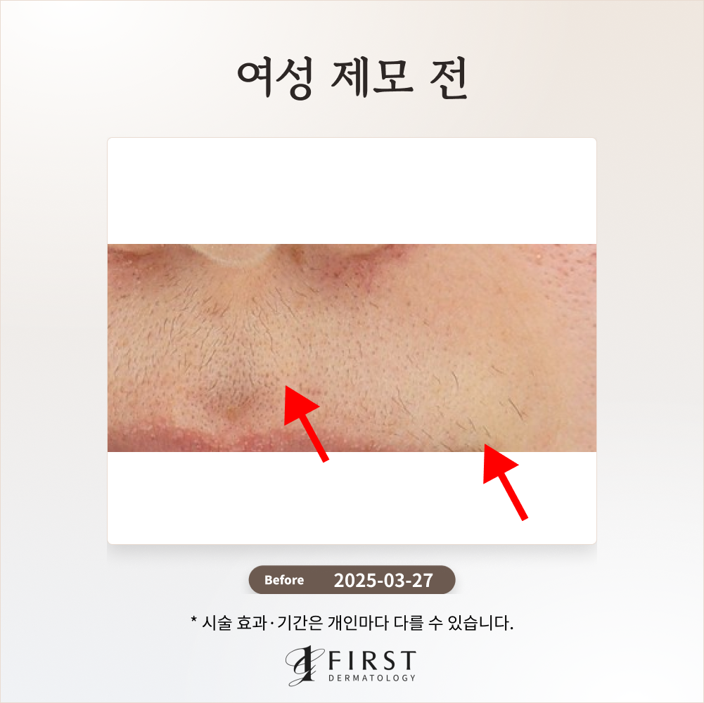30대 여성 제모 1회 효과는