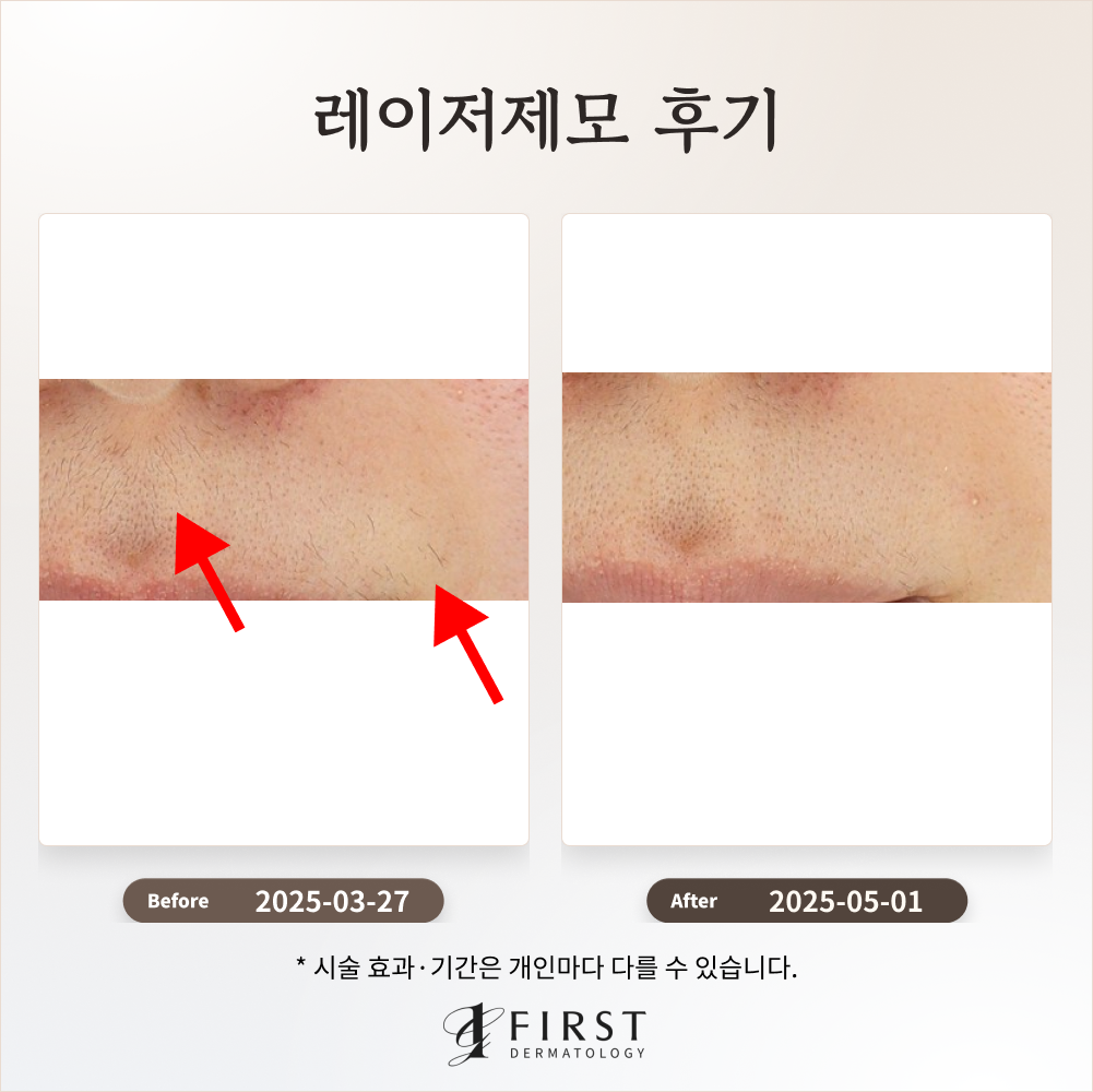 30대 여성 제모 1회 효과는